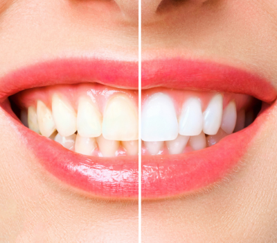 Professional Zoom Teeth Whitening