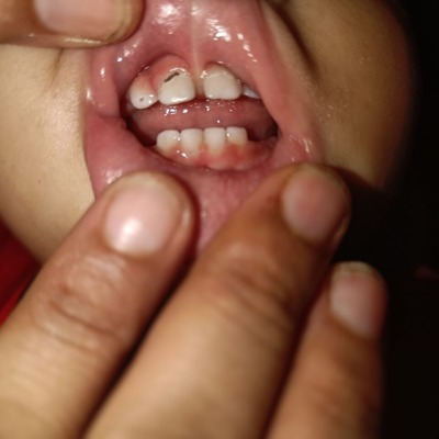 before treatment