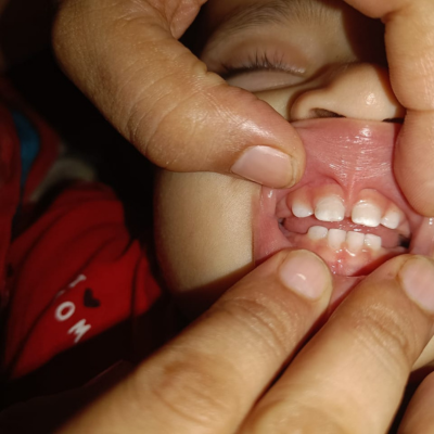After treatment