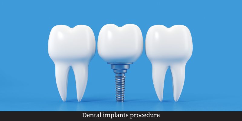 Dental implants procedure