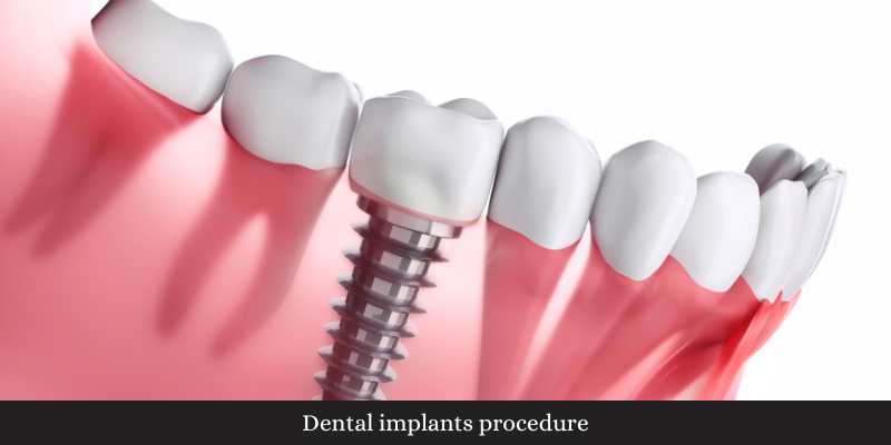 Dental implants procedure