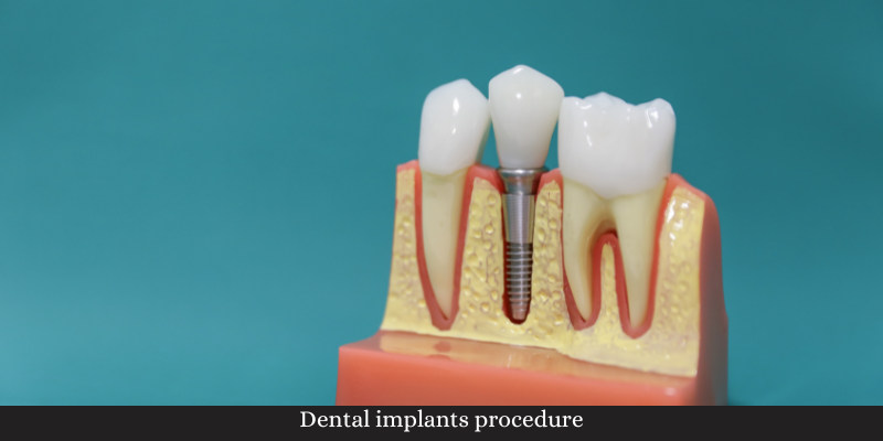 Same-day dental implants