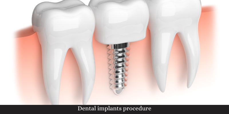Same-day dental implants