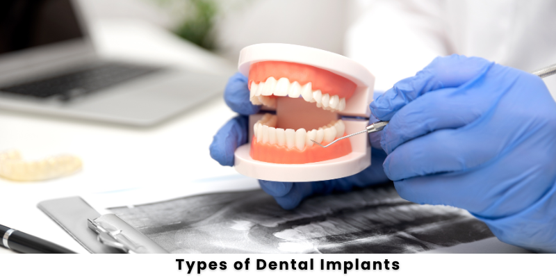 Types-of-Dental-Implants