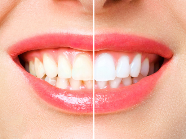 Why Professional Teeth Cleaning is Necessary​