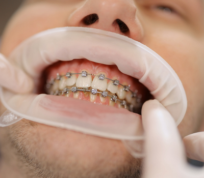 The Step-by-Step Orthodontic Treatment Process