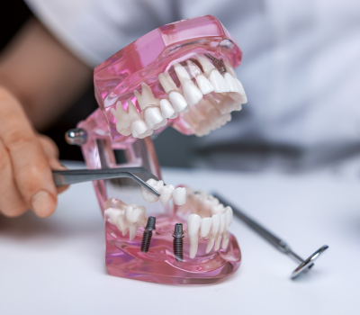 Restore Your Smile with a Strong & Natural-Looking Dental Bridge