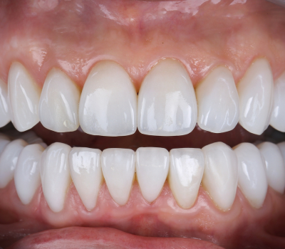 Dental Bridges or Implants? Compare & Choose the Right Option for You
