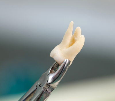 Understanding the Need for Wisdom Tooth Removal