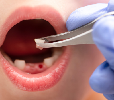 Signs That Wisdom Tooth Extraction May Be Necessary