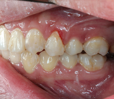 Gum Grafting