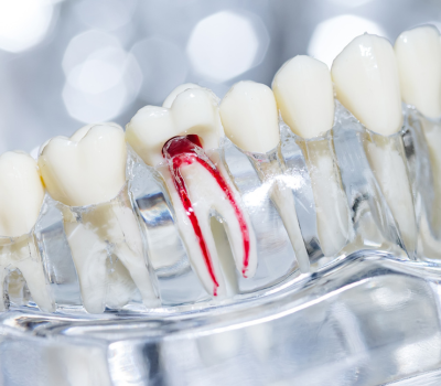 Single-Visit Root Canal​