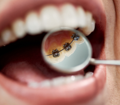 How Long Does Orthodontic Treatment Take?