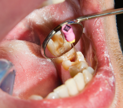 Re-Treatment Root Canal