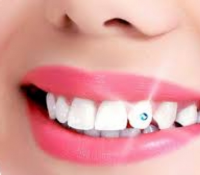 Who Can Get Tooth Jewellery?​