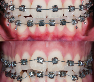 Different Types of Orthodontic Treatments Available
