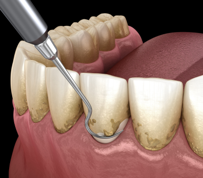 A Fast and Comfortable Treatment Process