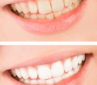 Erase Years of Stains in Just 60 Minutes!