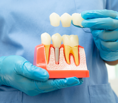 Your Permanent and Natural-Looking Tooth Replacement