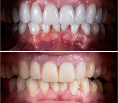 Long-Lasting Results with Minimal Tooth Alteration