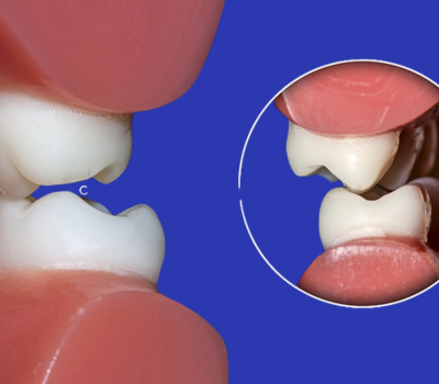 Identifying the Signs That You Need Splint Therapy​