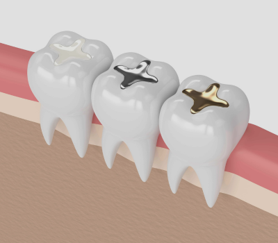 Types of Dental Fillings Available at Gentle Dental Clinic