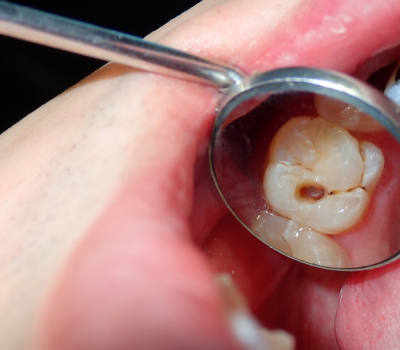 Dental Fillings: Restore & Protect Your Smile!