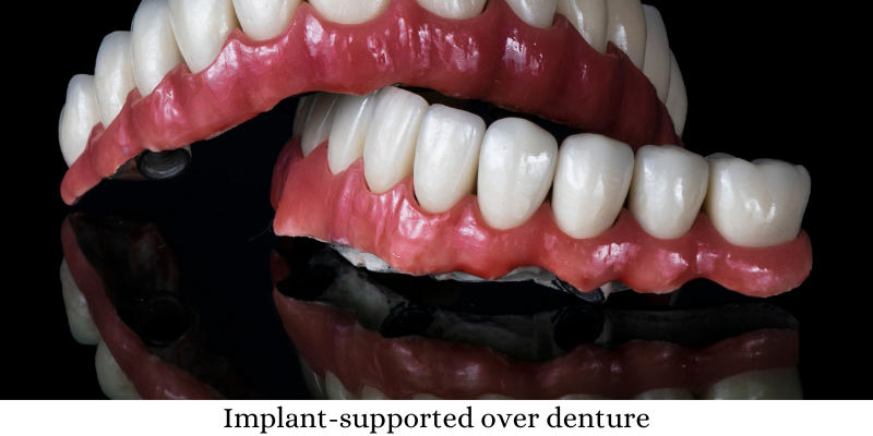 Implant-supported over denture