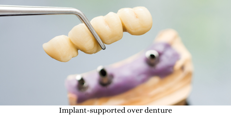 Implant-supported over denture