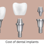 Cost of dental implants