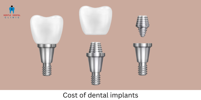 Cost of dental implants