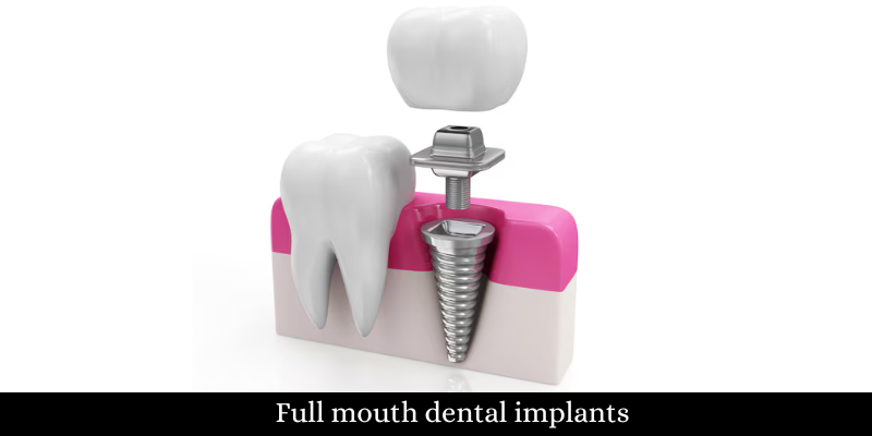 Full mouth dental implants
