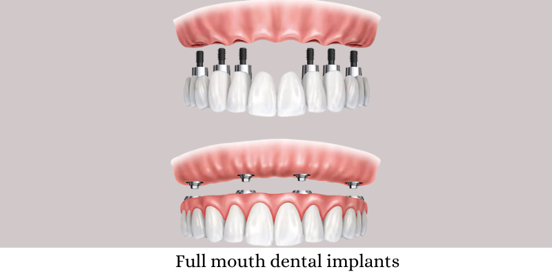 Full mouth dental implants