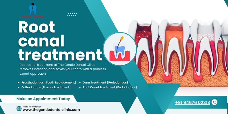 Root canal treatment (1)