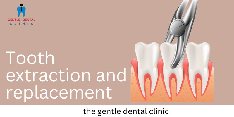 Tooth extraction and replacement in Gurugram