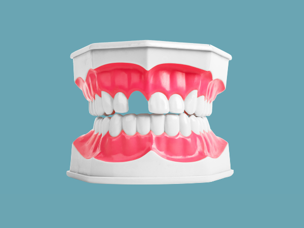 missing teeth
